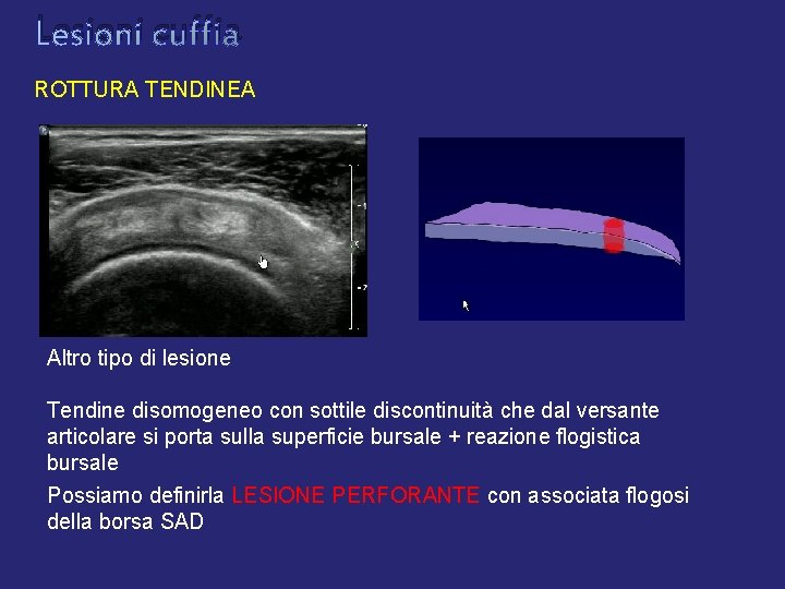 Lesioni cuffia ROTTURA TENDINEA Altro tipo di lesione Tendine disomogeneo con sottile discontinuità che Lesioni cuffia ROTTURA TENDINEA Altro tipo di lesione Tendine disomogeneo con sottile discontinuità che