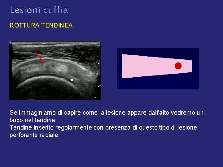 Lesioni cuffia ROTTURA TENDINEA Se immaginiamo di capire come la lesione appare dall’alto vedremo Lesioni cuffia ROTTURA TENDINEA Se immaginiamo di capire come la lesione appare dall’alto vedremo