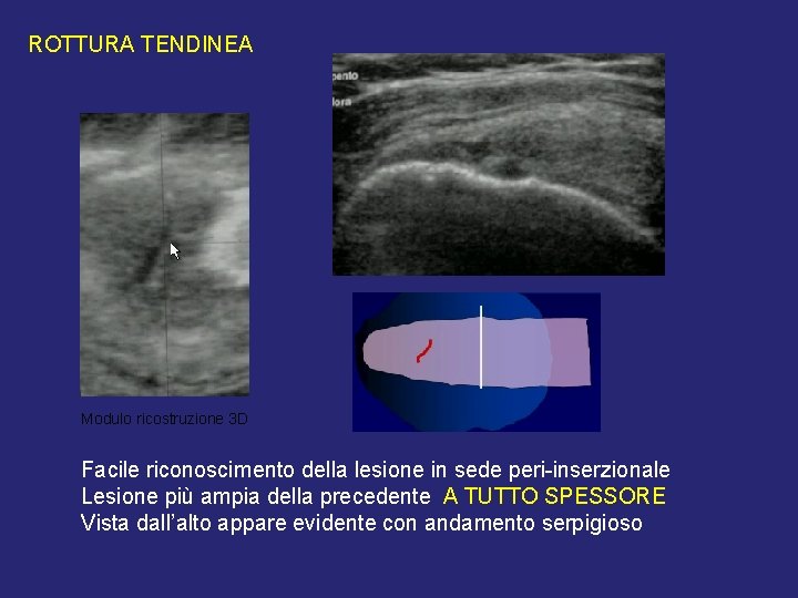 ROTTURA TENDINEA Modulo ricostruzione 3 D Facile riconoscimento della lesione in sede peri-inserzionale Lesione ROTTURA TENDINEA Modulo ricostruzione 3 D Facile riconoscimento della lesione in sede peri-inserzionale Lesione