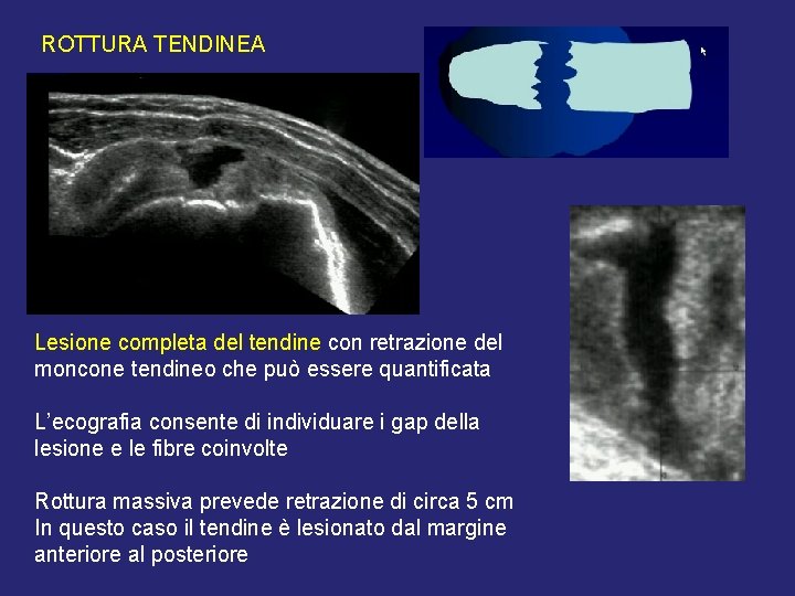 ROTTURA TENDINEA Lesione completa del tendine con retrazione del moncone tendineo che può essere ROTTURA TENDINEA Lesione completa del tendine con retrazione del moncone tendineo che può essere