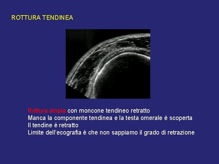 ROTTURA TENDINEA Rottura ampia con moncone tendineo retratto Manca la componente tendinea e la ROTTURA TENDINEA Rottura ampia con moncone tendineo retratto Manca la componente tendinea e la