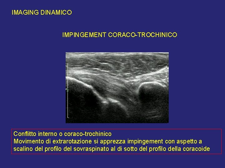 IMAGING DINAMICO IMPINGEMENT CORACO-TROCHINICO Conflitto interno o coraco-trochinico Movimento di extrarotazione si apprezza impingement IMAGING DINAMICO IMPINGEMENT CORACO-TROCHINICO Conflitto interno o coraco-trochinico Movimento di extrarotazione si apprezza impingement