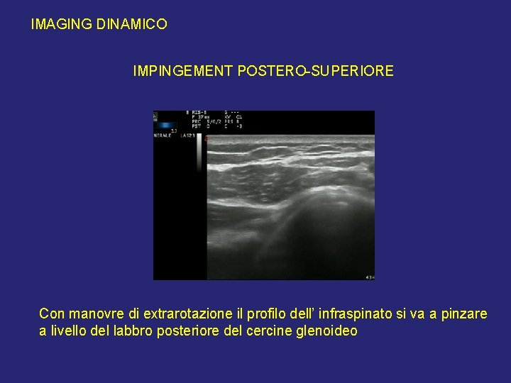 IMAGING DINAMICO IMPINGEMENT POSTERO-SUPERIORE Con manovre di extrarotazione il profilo dell’ infraspinato si va IMAGING DINAMICO IMPINGEMENT POSTERO-SUPERIORE Con manovre di extrarotazione il profilo dell’ infraspinato si va