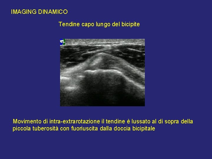IMAGING DINAMICO Tendine capo lungo del bicipite Movimento di intra-extrarotazione il tendine è lussato IMAGING DINAMICO Tendine capo lungo del bicipite Movimento di intra-extrarotazione il tendine è lussato