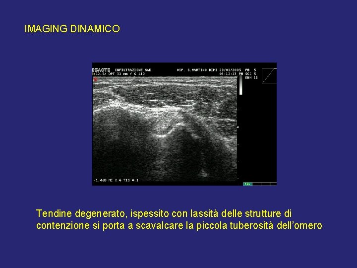 IMAGING DINAMICO Tendine degenerato, ispessito con lassità delle strutture di contenzione si porta a IMAGING DINAMICO Tendine degenerato, ispessito con lassità delle strutture di contenzione si porta a