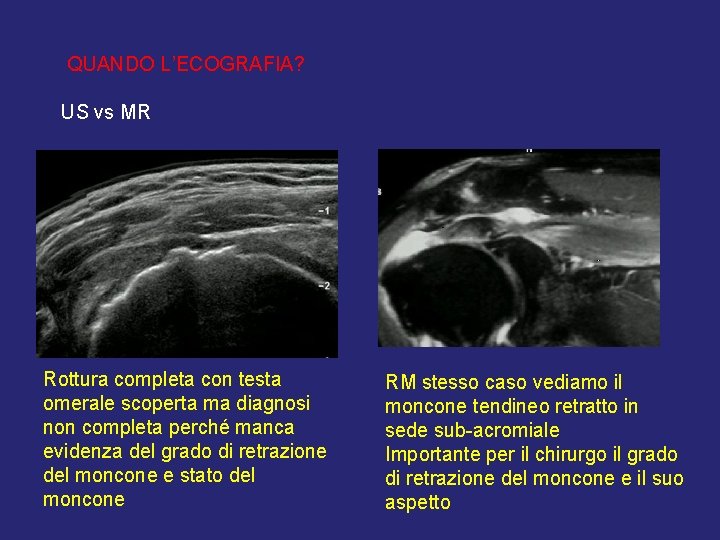 QUANDO L’ECOGRAFIA? US vs MR Rottura completa con testa omerale scoperta ma diagnosi non QUANDO L’ECOGRAFIA? US vs MR Rottura completa con testa omerale scoperta ma diagnosi non
