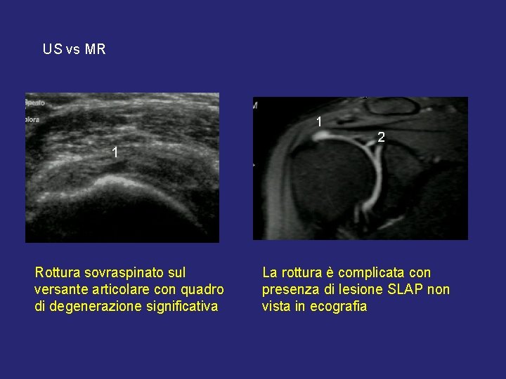 US vs MR Rottura sovraspinato sul versante articolare con quadro di degenerazione significativa La US vs MR Rottura sovraspinato sul versante articolare con quadro di degenerazione significativa La