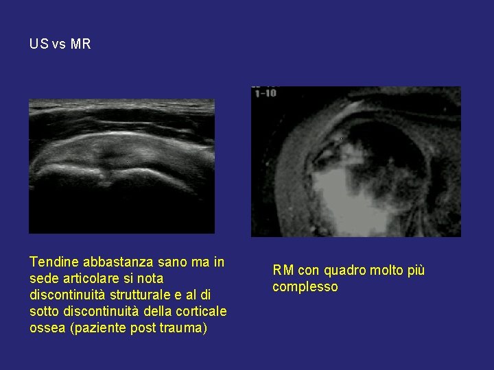 US vs MR Tendine abbastanza sano ma in sede articolare si nota discontinuità strutturale US vs MR Tendine abbastanza sano ma in sede articolare si nota discontinuità strutturale