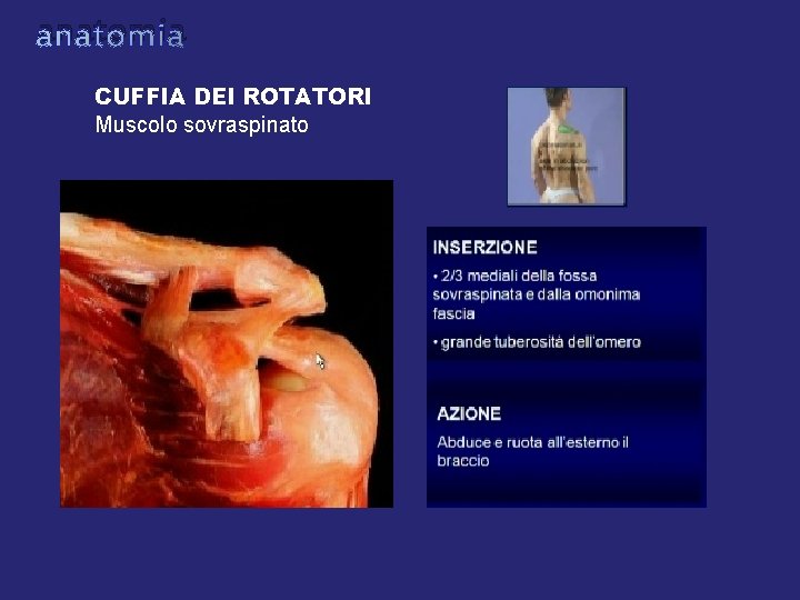 anatomia CUFFIA DEI ROTATORI Muscolo sovraspinato anatomia CUFFIA DEI ROTATORI Muscolo sovraspinato