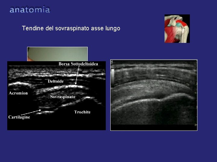 anatomia Tendine del sovraspinato asse lungo anatomia Tendine del sovraspinato asse lungo