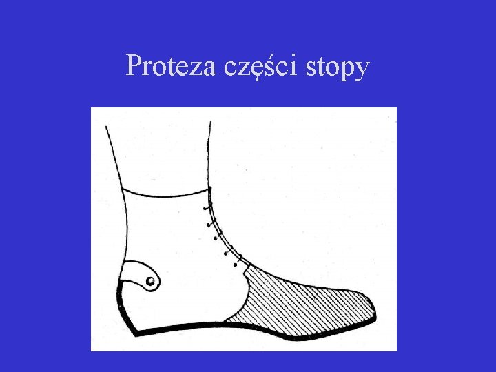 Proteza części stopy 