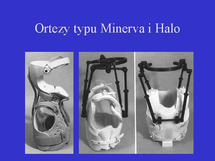 Ortezy typu Minerva i Halo 