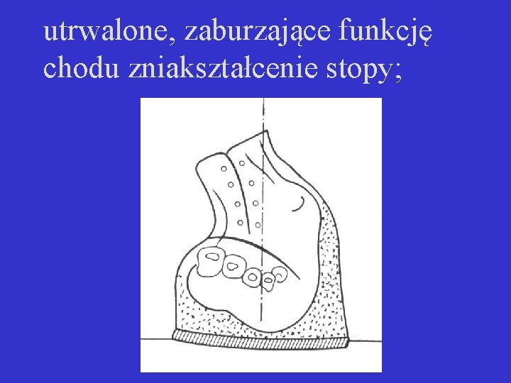 utrwalone, zaburzające funkcję chodu zniakształcenie stopy; 