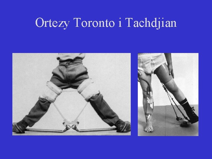 Ortezy Toronto i Tachdjian 