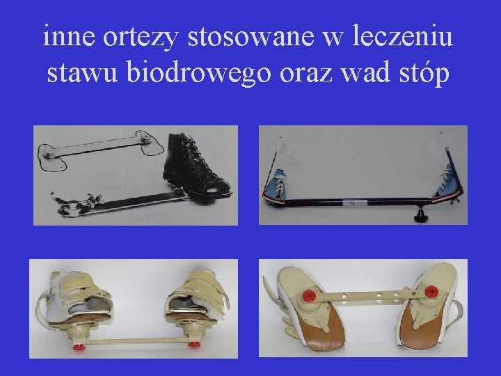 inne ortezy stosowane w leczeniu stawu biodrowego oraz wad stóp 