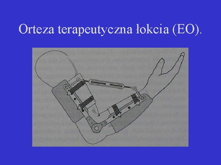 Orteza terapeutyczna łokcia (EO). 