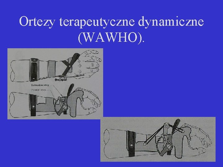 Ortezy terapeutyczne dynamiczne (WAWHO). 