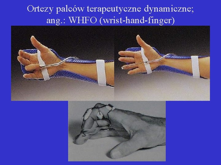 Ortezy palców terapeutyczne dynamiczne; ang. : WHFO (wrist-hand-finger) 