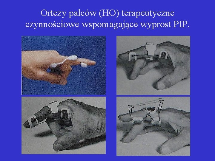 Ortezy palców (HO) terapeutyczne czynnościowe wspomagające wyprost PIP. 