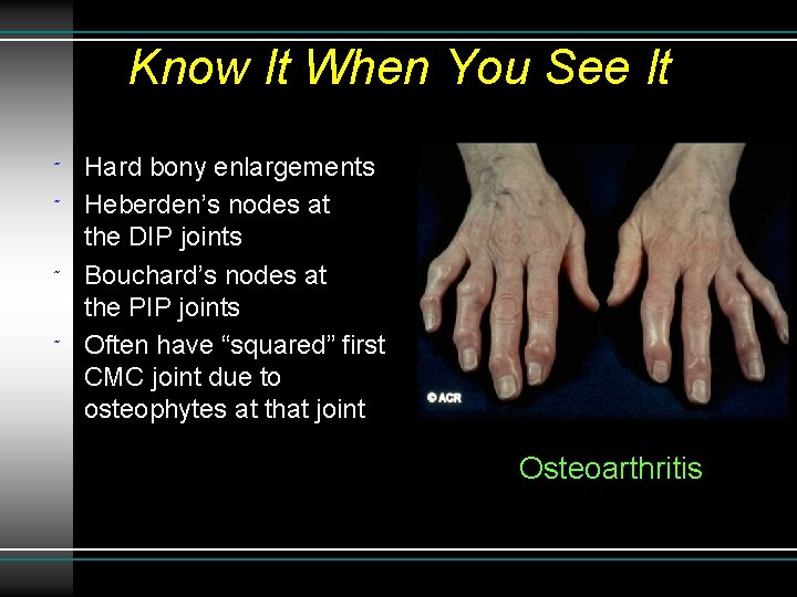Know It When You See It ˜ ˜ Hard bony enlargements Heberden’s nodes at