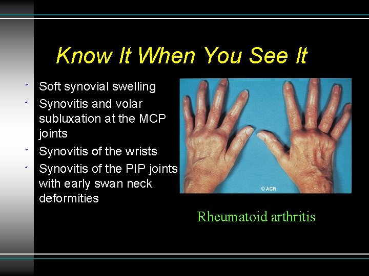 Know It When You See It ˜ ˜ Soft synovial swelling Synovitis and volar