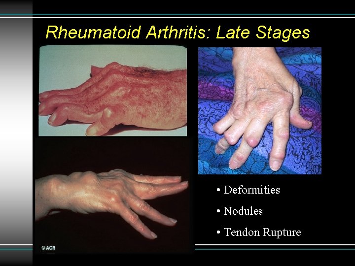 Rheumatoid Arthritis: Late Stages • Deformities • Nodules • Tendon Rupture 