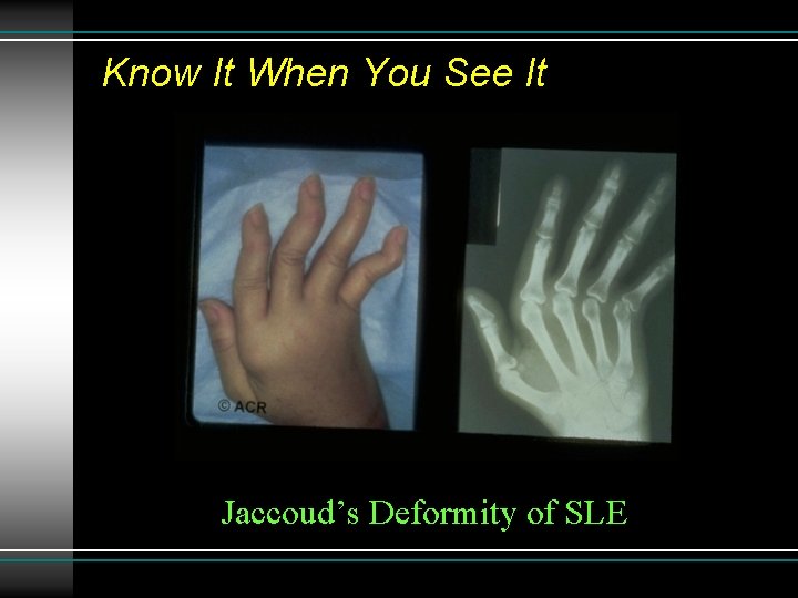 Know It When You See It Jaccoud’s Deformity of SLE 
