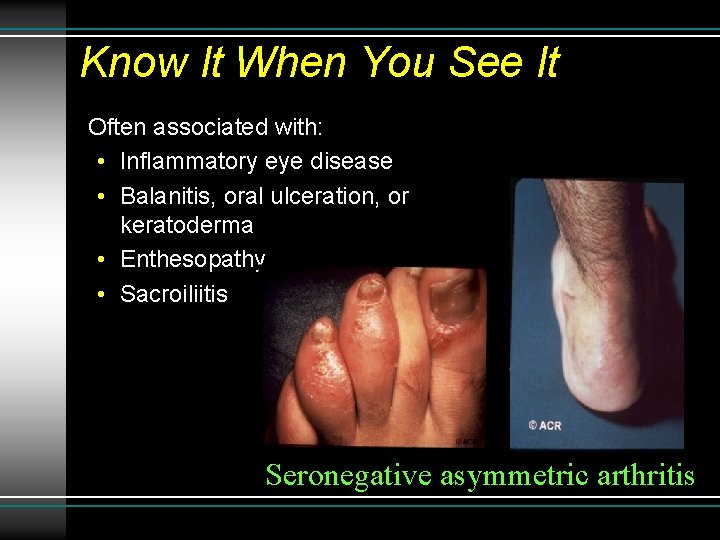 Know It When You See It Often associated with: • Inflammatory eye disease •