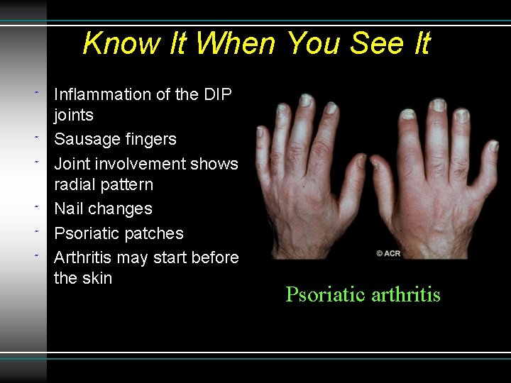 Know It When You See It ˜ ˜ ˜ Inflammation of the DIP joints