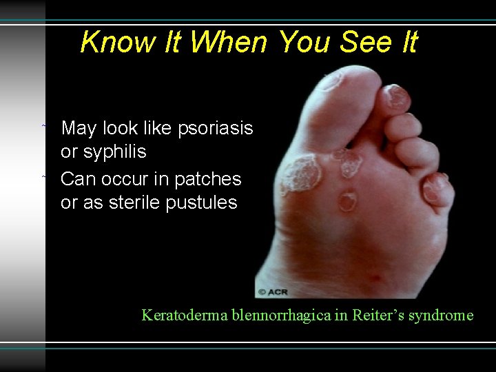 Know It When You See It ˜ ˜ May look like psoriasis or syphilis