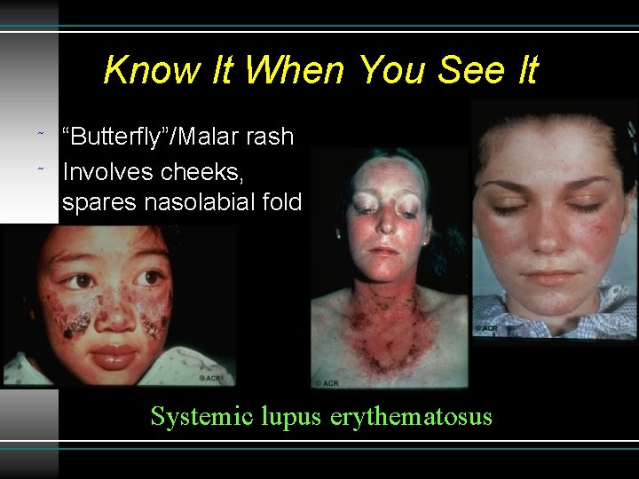 Know It When You See It ˜ ˜ “Butterfly”/Malar rash Involves cheeks, spares nasolabial