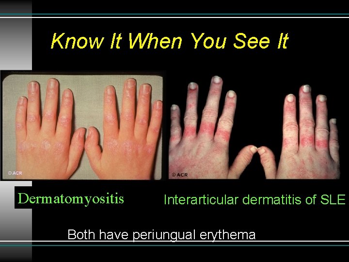 Know It When You See It Dermatomyositis Interarticular dermatitis of SLE Both have periungual