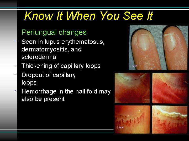 Know It When You See It Periungual changes ˜ ˜ Seen in lupus erythematosus,
