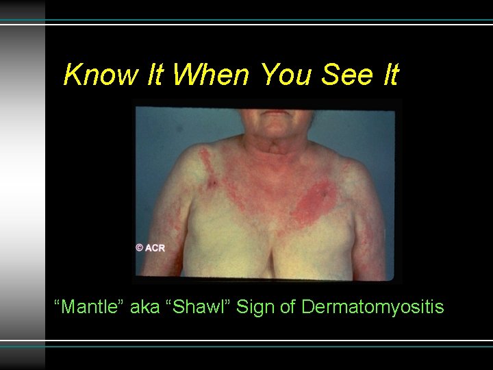 Know It When You See It “Mantle” aka “Shawl” Sign of Dermatomyositis 