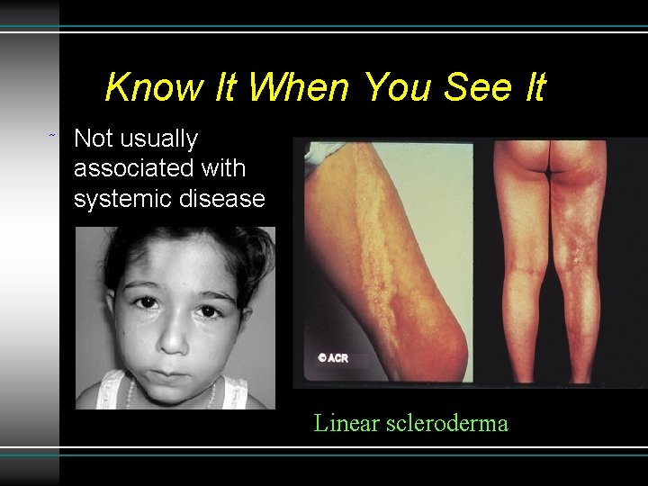 Know It When You See It ˜ Not usually associated with systemic disease Linear