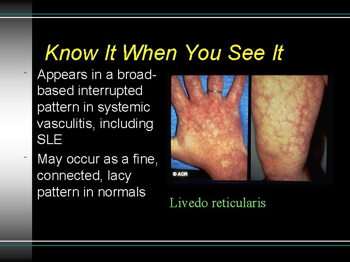 Know It When You See It ˜ ˜ Appears in a broadbased interrupted pattern