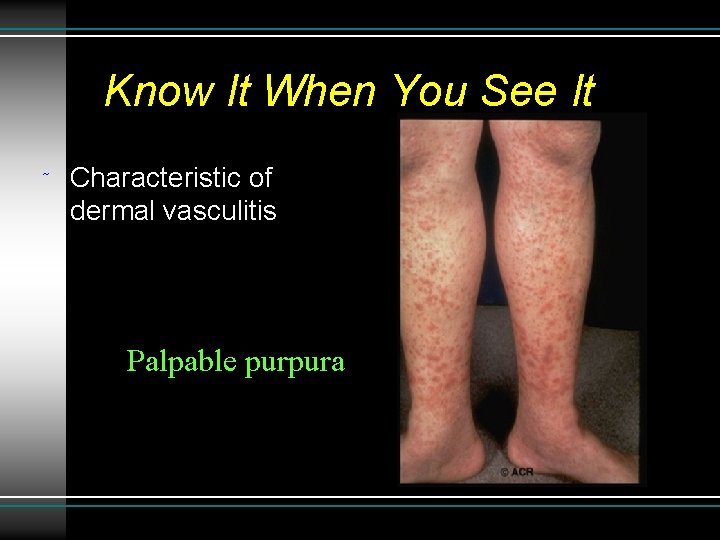 Know It When You See It ˜ Characteristic of dermal vasculitis Palpable purpura 