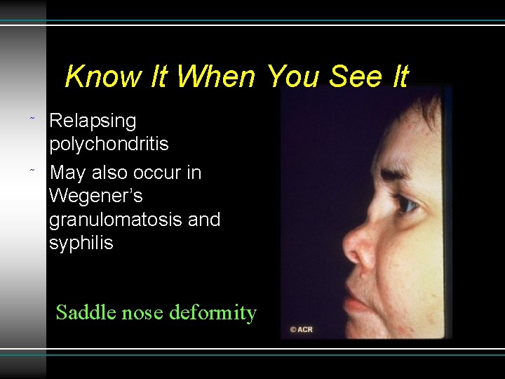 Know It When You See It ˜ ˜ Relapsing polychondritis May also occur in