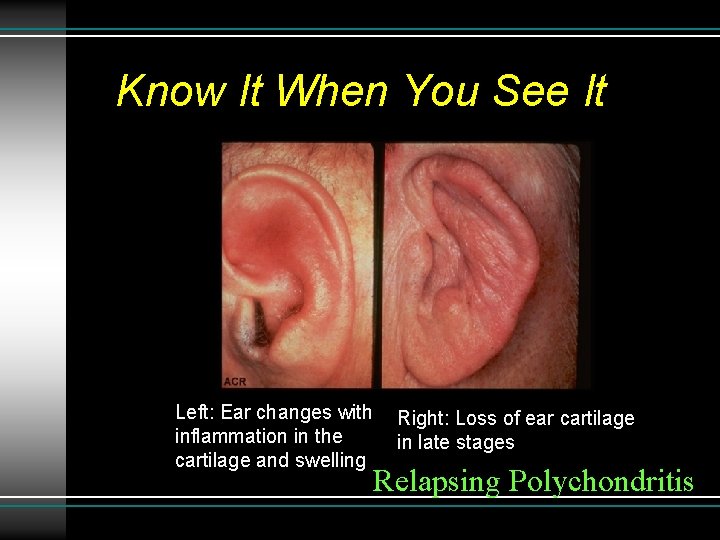 Know It When You See It Relapsing polychondritis Left: Ear changes with inflammation in