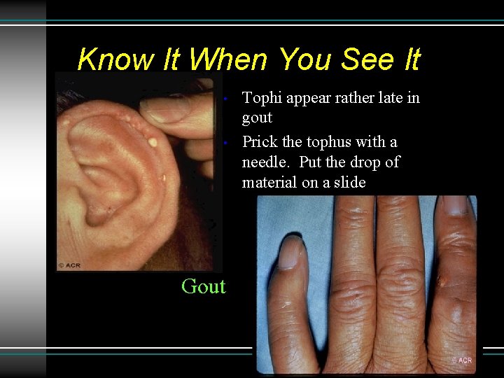 Know It When You See It • • Gout Tophi appear rather late in