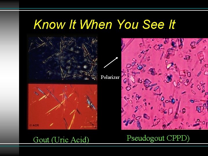 Know It When You See It Polarizer Gout (Uric Acid) Pseudogout CPPD) 