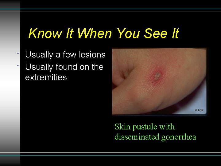 Know It When You See It ˜ ˜ Usually a few lesions Usually found