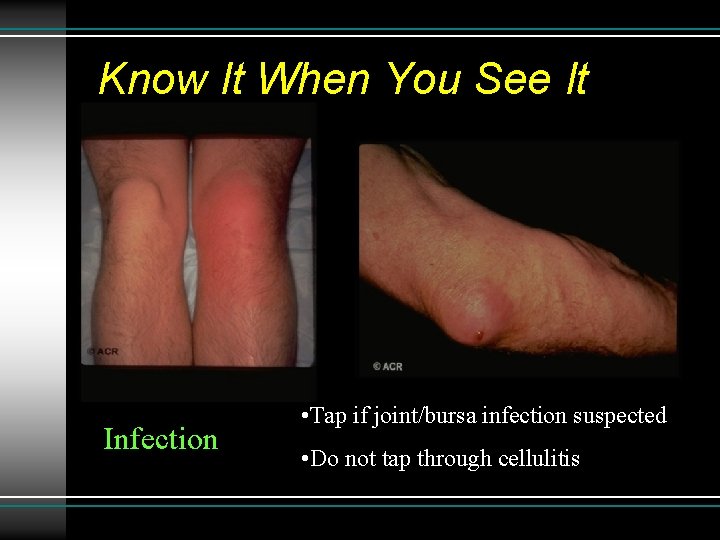 Know It When You See It Infection • Tap if joint/bursa infection suspected •