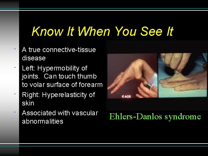 Know It When You See It ˜ ˜ A true connective-tissue disease Left: Hypermobility