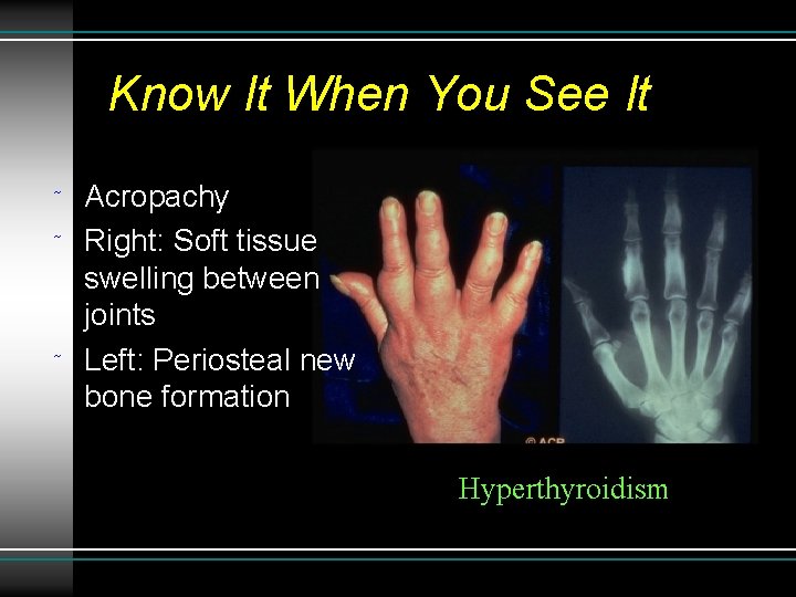 Know It When You See It ˜ ˜ ˜ Acropachy Right: Soft tissue swelling