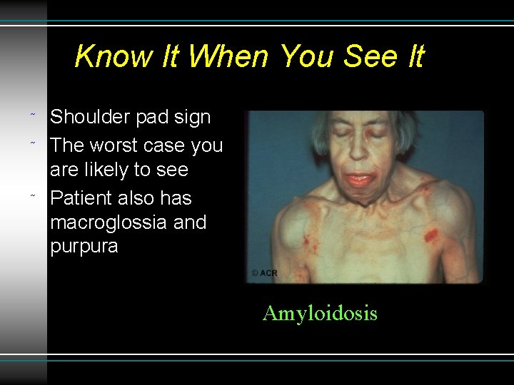 Know It When You See It ˜ ˜ ˜ Shoulder pad sign The worst