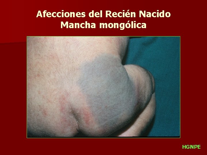 Afecciones del Recién Nacido Mancha mongólica HGNPE 