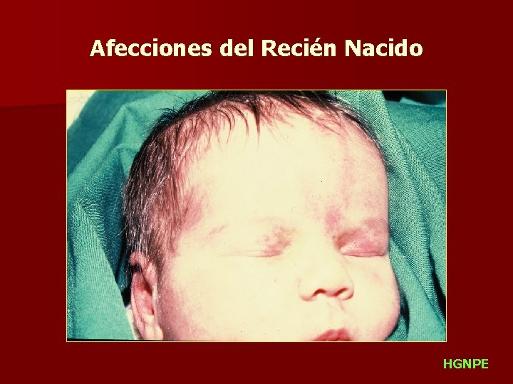 Afecciones del Recién Nacido HGNPE 