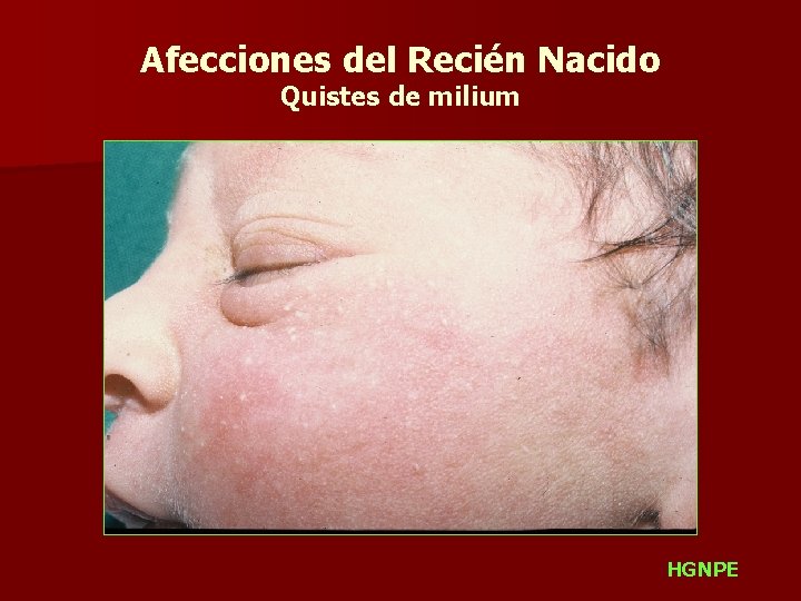 Afecciones del Recién Nacido Quistes de milium HGNPE 