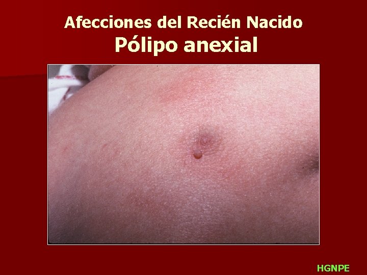 Afecciones del Recién Nacido Pólipo anexial HGNPE 